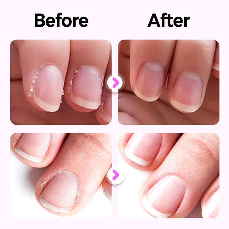 đ„âšKaufe 1 und erhalte 1 gratis đ2025 Neuer und verbesserter 3-in-1-Nagelpflegestift.